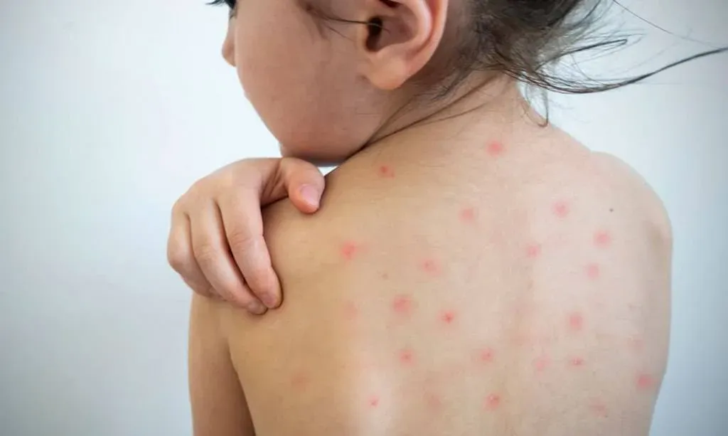 Vacuna triple viral y calendario de vacunación contra sarampión
